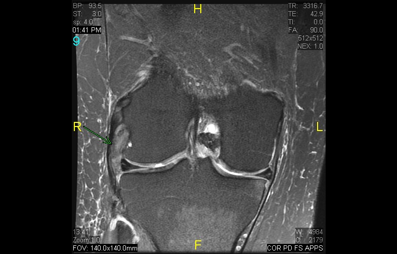 Figure 4 for case Popliteus tendinosis